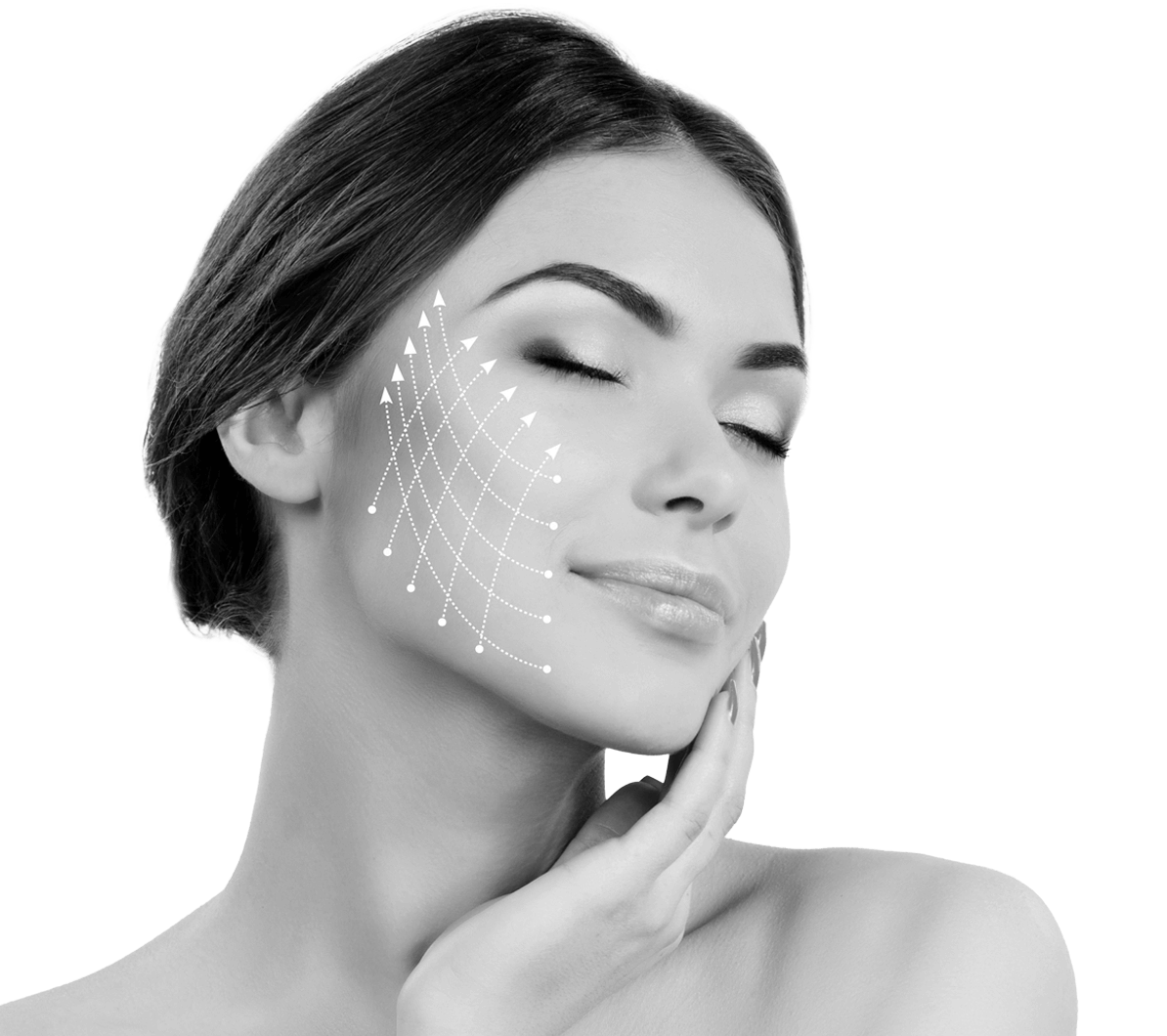 ITA-threadlift-image