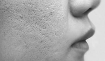 acne-scars-1