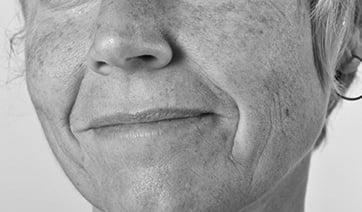 age-spots-face-1