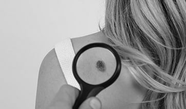 birthmark-shoulder-1