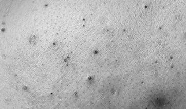 blackheads-closeup-1