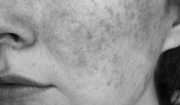 face-rosacea-closeup-1