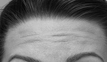 forehead-lines-1