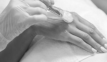 hand-chemical-peel-1
