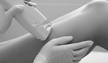 laser-hair-removal-legs-1