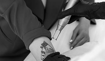 laser-tattoo-removal-arm-1