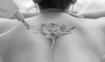 laser-tattoo-removal-back-1