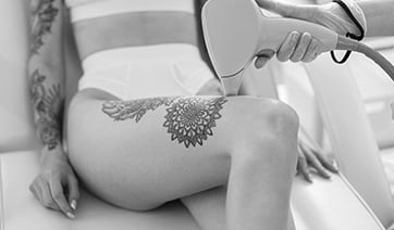 laser-tattoo-removal-legs-1