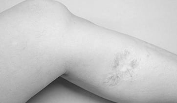 leg-scar-1