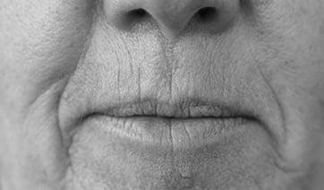 perioral-lines-2