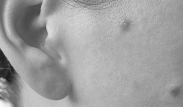 precancerous-spots-face-1