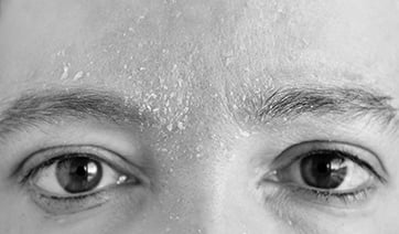 psoriasis-in-face-1