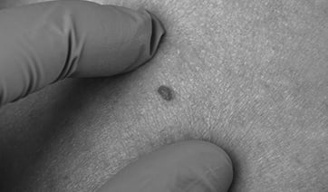 small-hemangioma-1