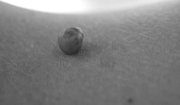 strawberry-hemangioma-1