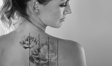 tattoo-removal-1