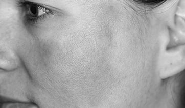 uneven-pigment-face-woman-1