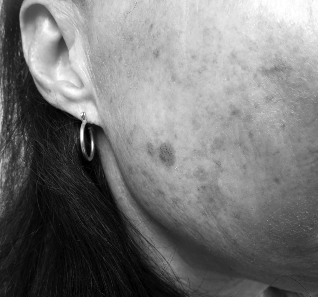 unevent-skin-tone