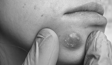 vascular-malformation-chin-1