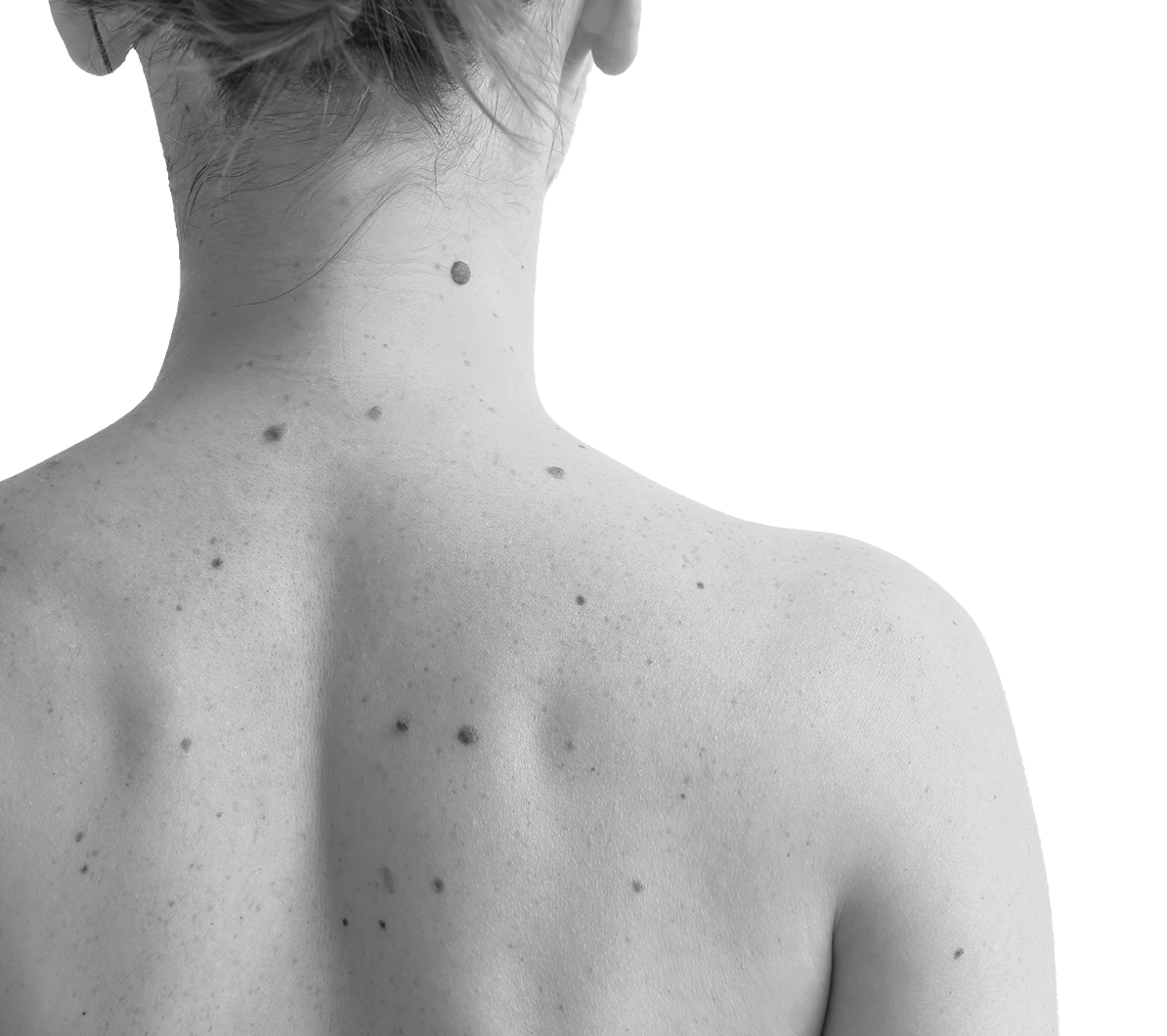 woman-back-birthmarks-1